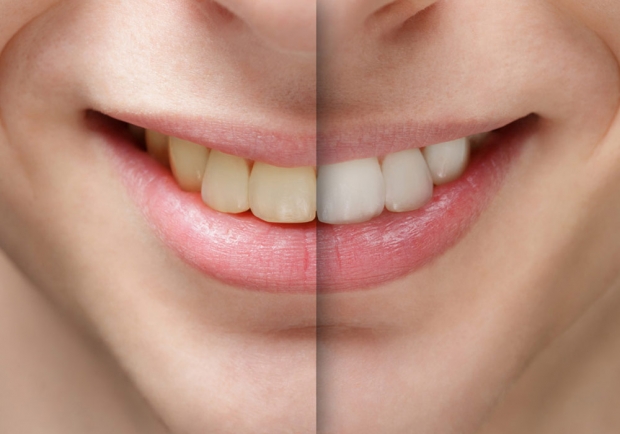 Blanchiment des dents