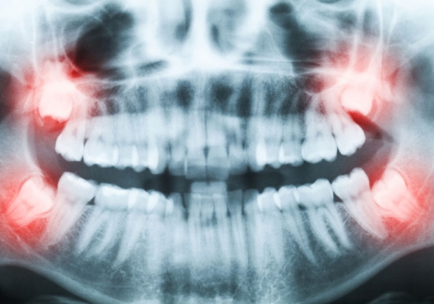 Chirurgies mineures (ex : dents de sagesse)