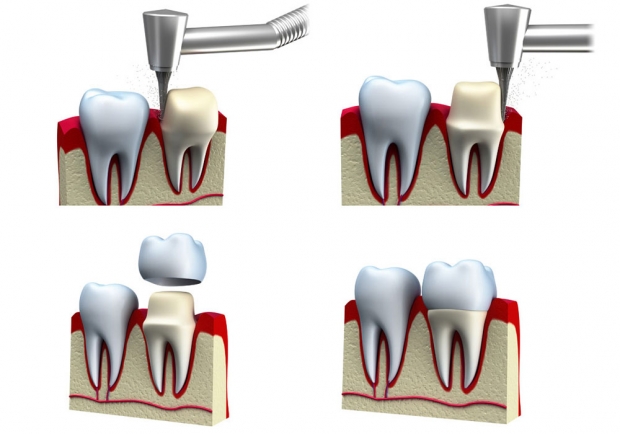 Couronne en c&eacute;ramique en une visite (Cerec)